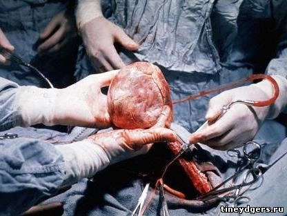 операция по пересадке сердца